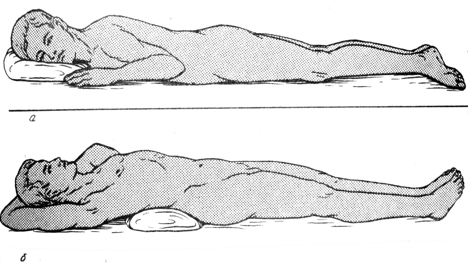 Положение позвоночника лежа на спине. Положение тела при переломе позвоночника.